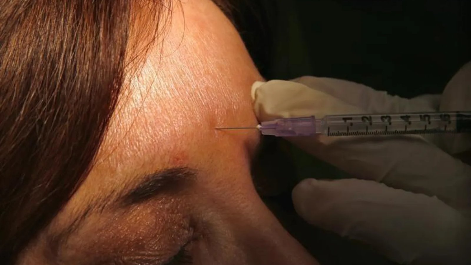 نصائح بعد حقن البوتوكس: كيفية العناية للحصول على أفضل النتائج